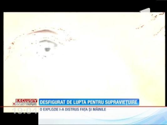 Un clujean desfigurat de o explozie, discriminat de angajatori