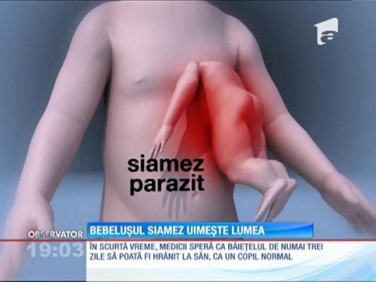 Bebeluşul siamez şi-a revenit perfect