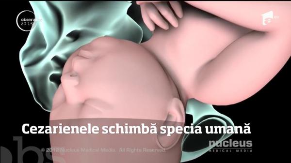Naşterile prin cezariană schimbă specia umană