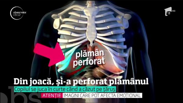 Un copil de 8 ani e în stare critică, după ce un ţăruş peste care a căzut, jucându-se, i-a perforat un plămân