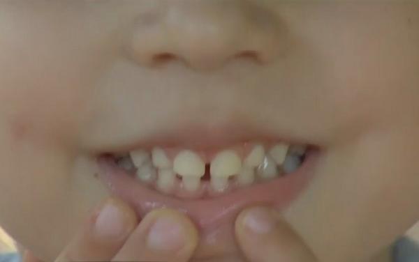 Şapte din zece copii români care ajung la dentist au carii, iar  jumătate dintre ei au probleme mai grave