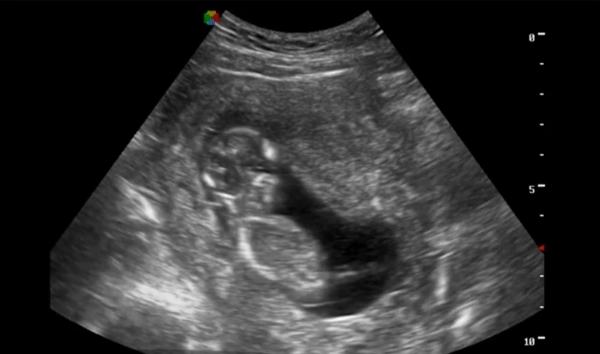 Paracetamolul administrat în timpul sarcinii poate afecta sănătatea fătului (studiu Harvard)