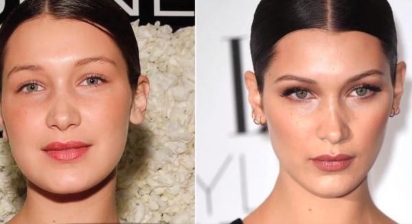 Bichectomia, secretul frumuseții vedetelor. Sfaturi pentru o intervenţie estetică reuşită (Video)y