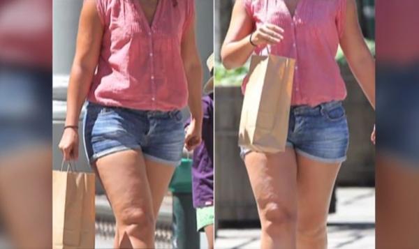 Celulita nu apare de la mâncare. Explicațiile medicilor dermatologi