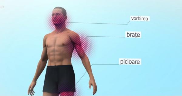 Sănătate, România. Patru români mor, în fiecare oră, în urma unui accident vascular cerebral