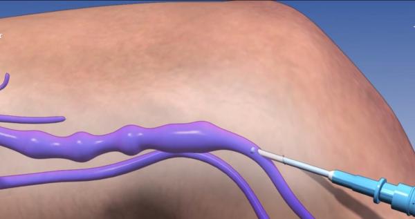 Cum tratăm și prevenim varicele. Ce sfaturi ne dau specialiștii