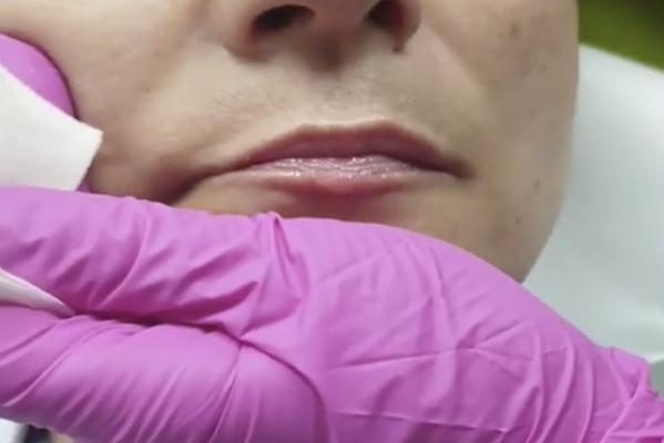 Intervențiile estetice, fără reacții adverse la vaccinarea anti-Covid