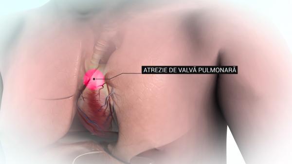 ANIMAŢIE GRAFICĂ. Cum a decurs intervenţia pe cord a bebeluşului, realizată în premieră în România. Momente de bucurie pentru părinţii micuţului. "Îmi doream doar să fie sănătos"