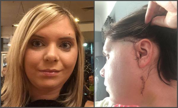 O femeie, desfigurată după ce şi-a dislocat mandibula încercând să mănânce un burger de la KFC, în Marea Britanie