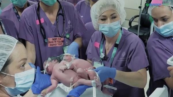 Surori siameze, care s-au născut cu craniile unite, au fost separate după o operaţie rară în Israel, ce a necesitat luni de pregătire - VIDEO