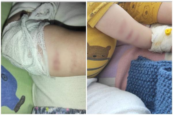 "Tratament" cu vânătăi, administrat unui copilaş de un an la Spitalul din Feteşti. Eduard poartă pe piele urmele neglijenţei asistentelor