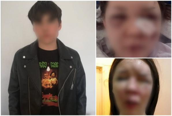 Desfigurată din gelozie. Fata de 15 ani din Turnu Măgurele, snopită în bătaie de fostul iubit, are nevoie de reconstrucţie facială