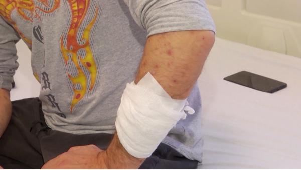 Variola maimuţei: vaccinul nu funcţionează în cazul celor infectaţi, iar boala nu are tratament specific