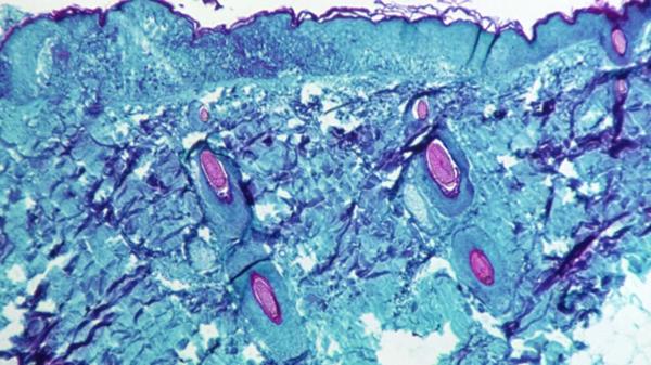 Un român ar fi adus variola maimuţei în Grecia. Tânărul de 29 de ani este în izolare, internat într-un spital din Atena