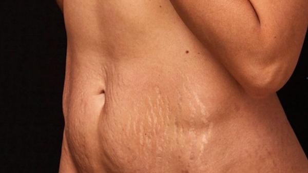 Diastaza abdominală. Care sunt cauzele, cum se manifestă şi ce tratamente există