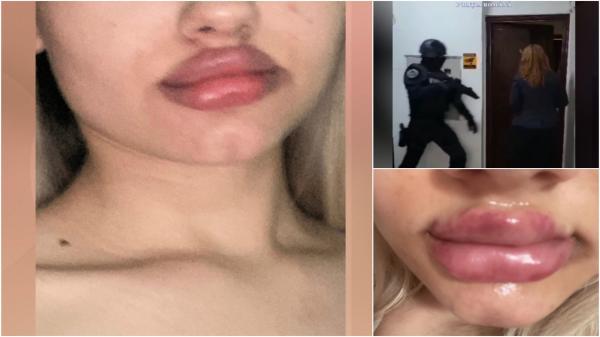 Au vrut operaţii estetice low cost şi au ajuns mutilate de o tânără de 23 de ani. "Aveam buza într-o parte, era oribilă"