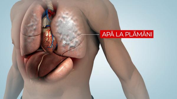 Boala misterioasă care i-a pus pe gânduri pe medicii din toată lumea a ajuns în România: "Sindromul plămânilor albi"