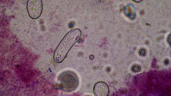 O infecție bacteriană rară se răspândește rapid în Japonia. Boala e fatală în 30% dintre cazuri