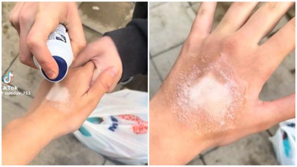 Provocarea deodorantului spray pe piele a ajuns în România. Tinerii se aleg cu cicatrici pe viață