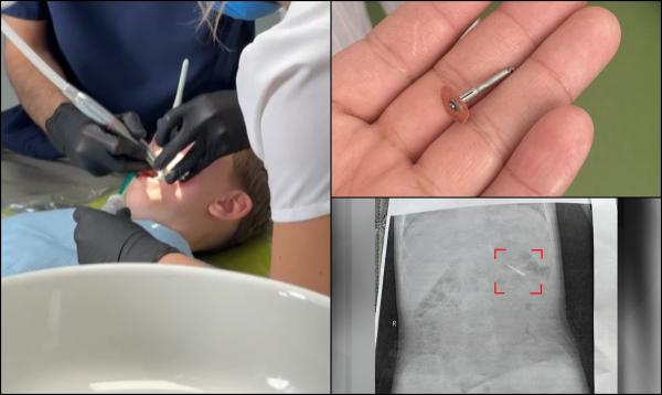 Scandal la o clinică stomatologică din Iaşi. Medicul i-a scăpat unui copil de 5 ani o freză pe gât