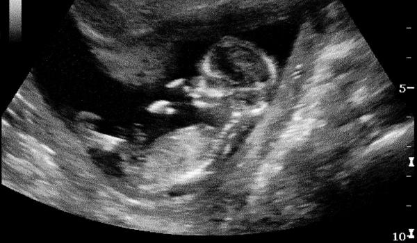 Dilema nașterii: natural sau cezariană? Trendul periculos care cuprinde și România