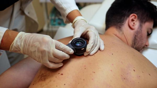 Primul vaccin care previne recidiva cancerului de piele. Este bazat pe tehnologia ARN