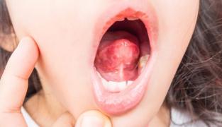 Herpangina la copii: cauze, simptome, tratament