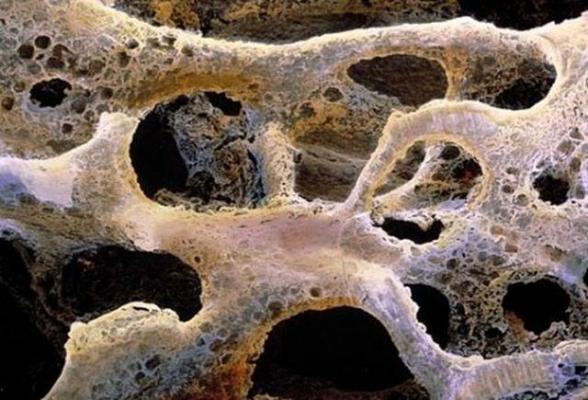 Cel mai vechi caz de CANCER la om, descoperit într-o fosilă veche de 1,7 milioane de ani. VIDEO