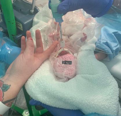Un bebeluș născut prematur, la 490 grame, a fost ținut într-o pungă de sandviș ca să supraviețuiască, în Anglia