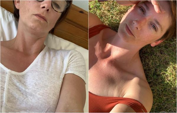 Colaj cu două poze de profil ale lui Stephanie Dubois: la soare, la sosirea în Cipru, şi în pat, după prima doză de vaccin AstraZeneca