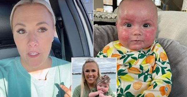 Mama unei fetițe cu alergie severă la lapte a împărtășit poze cu erupțiile dureroase pe care micuța din SUA le îndură