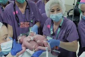 Surori siameze, care s-au născut cu craniile unite, au fost separate după o operaţie rară în Israel, ce a necesitat luni de pregătire - VIDEO