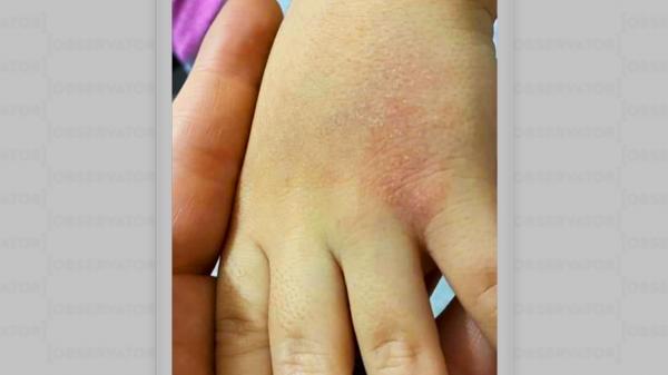 Tot mai mulți copii se întorc de la școală cu iritații pe piele și dermatite. Părinții dau vina pe dezinfectanți și caută soluții