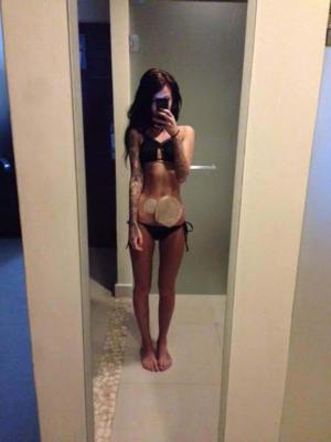 Imagini ŞOCANTE! O femeie s-a pozat în bikini şi cu punga de colostomie