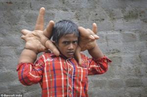 Un băiat din India ŞOCHEAZĂ LUMEA! Cum arată mâinile lui