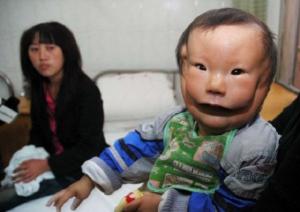Caz UNIC în lume: Băieţelul condamnat la SUFERINŢĂ. S-a născut cu o faţă dublă (GALERIE FOTO)