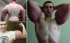 Imagini incredibile! Un fost soldat riscă să rămână paralizat, după ce și-a injectat ulei în bicepși pentru a arăta ca Popeye marinarul (VIDEO)