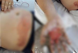 Imagini șocante! Un tânăr din Bacău a suferit arsuri grave după ce i-a explodat bateria de la țigara electronică