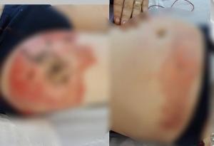 Imagini șocante! Un tânăr din Bacău a suferit arsuri grave după ce i-a explodat bateria de la țigara electronică