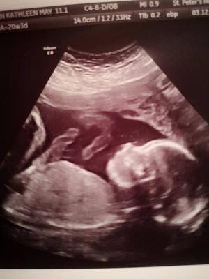 Copilul nenăscut al unei tinere însărcinate, operat şi pus înapoi în pântece de medici, la Londra