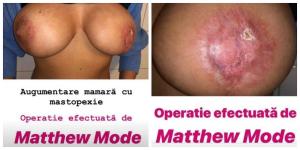 Cum arată sânii unei paciente mutilate de falsul medic italian Matteo Politi