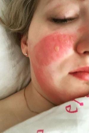 O asistentă din Rusia a ajuns la spitalul de arși din cauza măștilor dezinfectate cu clor. „Mi-au distrus fața!”