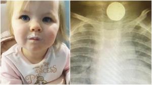 Descoperirea făcută de medici în cazul unei copile, la radiografie. Iniţial, medicii au crezut că fetiţa britanică are amigdalită