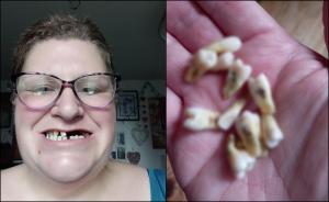 O mamă şi-a scos singură 11 dinţi, pentru că nu avea bani să meargă la un dentist, în UK: „Nu mai pot să zâmbesc, mi-am pierdut încrederea”