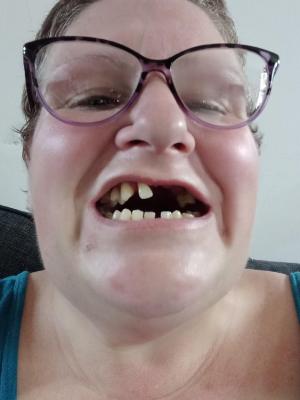 O mamă şi-a scos singură 11 dinţi, pentru că nu avea bani să meargă la un dentist, în UK: „Nu mai pot să zâmbesc, mi-am pierdut încrederea”