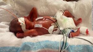 "Cel mai prematur" bebeluș din lume s-a născut la 21 de săptămâni și o zi, în SUA. Micuțul cântărea doar 420g