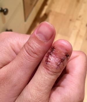 O femeie din Anglia și-a ascuns semnul de pe unghie ani întregi, din rușine, doar pentru a descoperi că are cancer