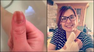 O femeie din Anglia și-a ascuns semnul de pe unghie ani întregi, din rușine, doar pentru a descoperi că are cancer