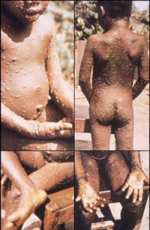 Un locuitor din Dallas, primul texan diagnosticat cu Monkeypox. Cum se transmite boala şi care sunt simptomele