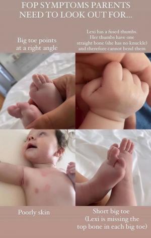 Diagnostic teribil pentru o fetiţă de doar 6 luni. Trupul bebeluşului "se transformă încet în stană de piatră"